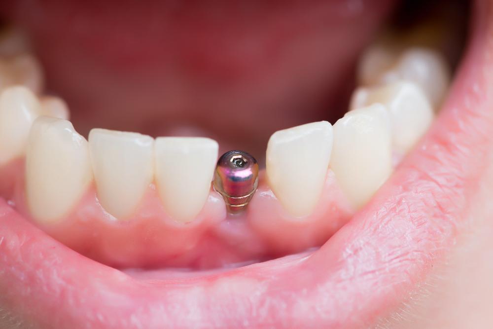 dental implants in preston 