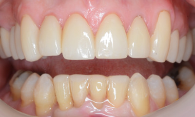 close up of patient's teeth after clear aligners and crowns