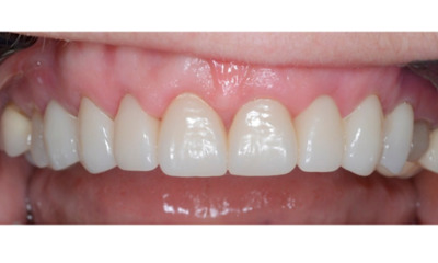 close up of patient with veneers