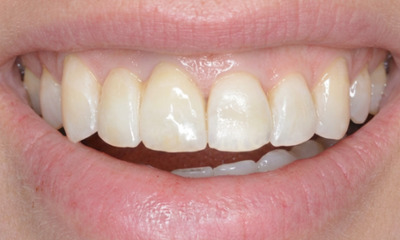 After treatment - Orthodontic and Dental Implant Treatment
