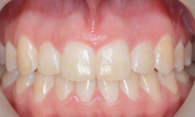 After treatment - Orthodontic Treatment