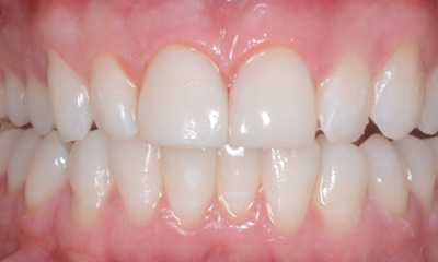After treatment - Teeth Whitening and Composite Fillings