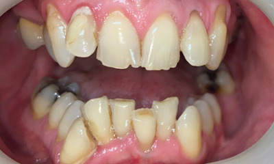patient with crooked upper and lower teeth