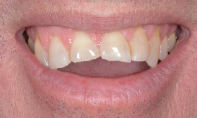 Before treatment - Edge Bonding for Chipped Teeth
