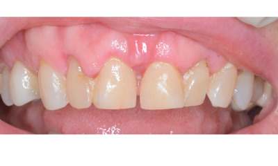 close up of patient with a gap between front teeth