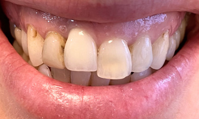 Before treatment - Orthodontic and Dental Implant Treatment