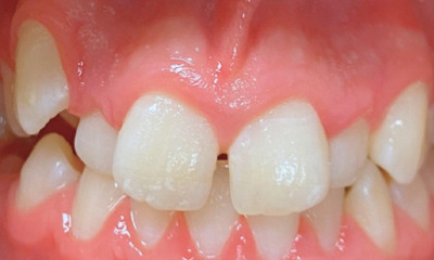 Before treatment - Orthodontic Treatment