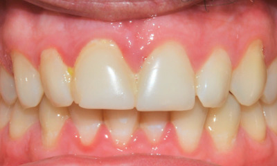 Before treatment - Teeth Whitening and Composite Fillings